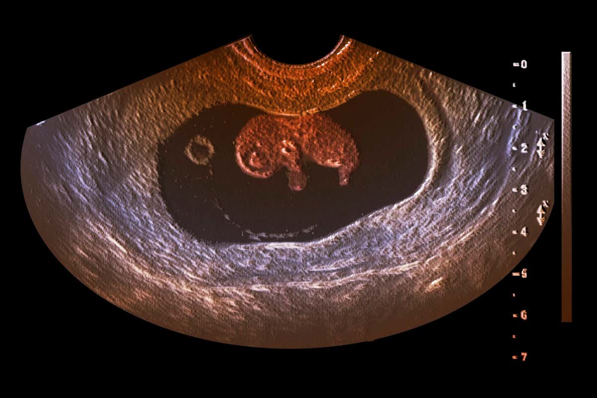 Coloured ultrasound scan of the abdomen of a pregnant female patient, showing a healthy nine week old foetus in the womb. At this age the foetus is about 5 cm long and weighs about 10 g.